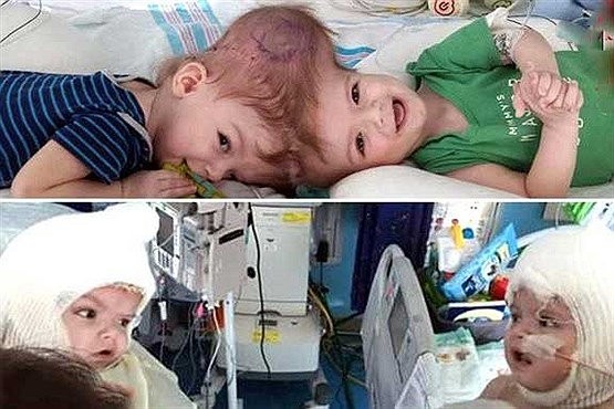 دیدار دوقلوهای به‌هم چسبیده از سر، بعد از عمل